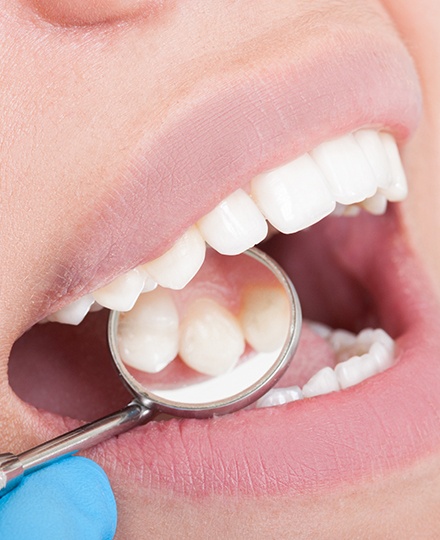 Dentist examining patient's smile after metal free dental restorations