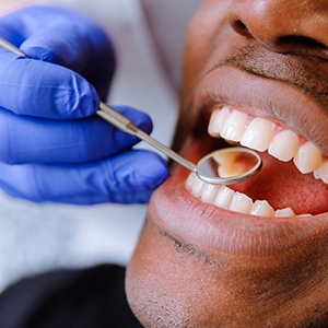 Emergency dentist in Tyler looking at patient's teeth with dental mirror