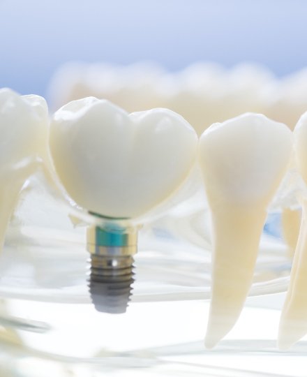Model dental implant supported dental crown