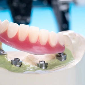 A mouth mold that contains four dental implants and a customized denture resting on top