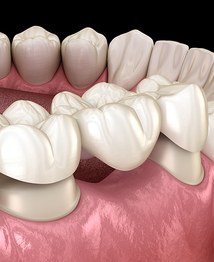 Animated dental bridge placement to replace missing teeth