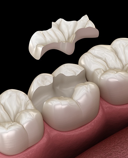 Animated smile during tooth colored filling restorative dentistry treatment