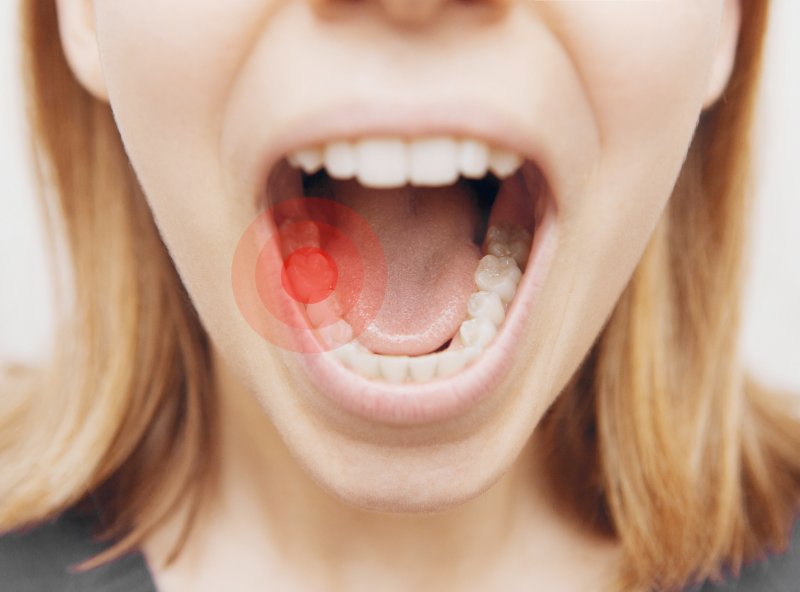 a person with their mouth open and a red dot signaling a cavity